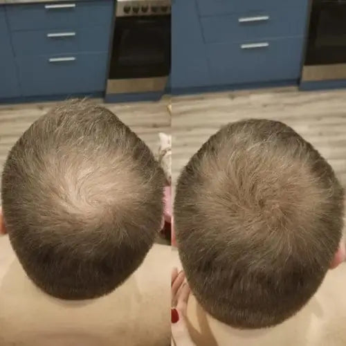 Ich habe wirklich die Dichte zurückbekommen, die ich mir für meine Haare gewünscht habe. Meine Frau ist einfach begeistert, und ich habe mein Selbstvertrauen komplett zurückgewonnen. Die Anwendung ist einfach und super praktisch.