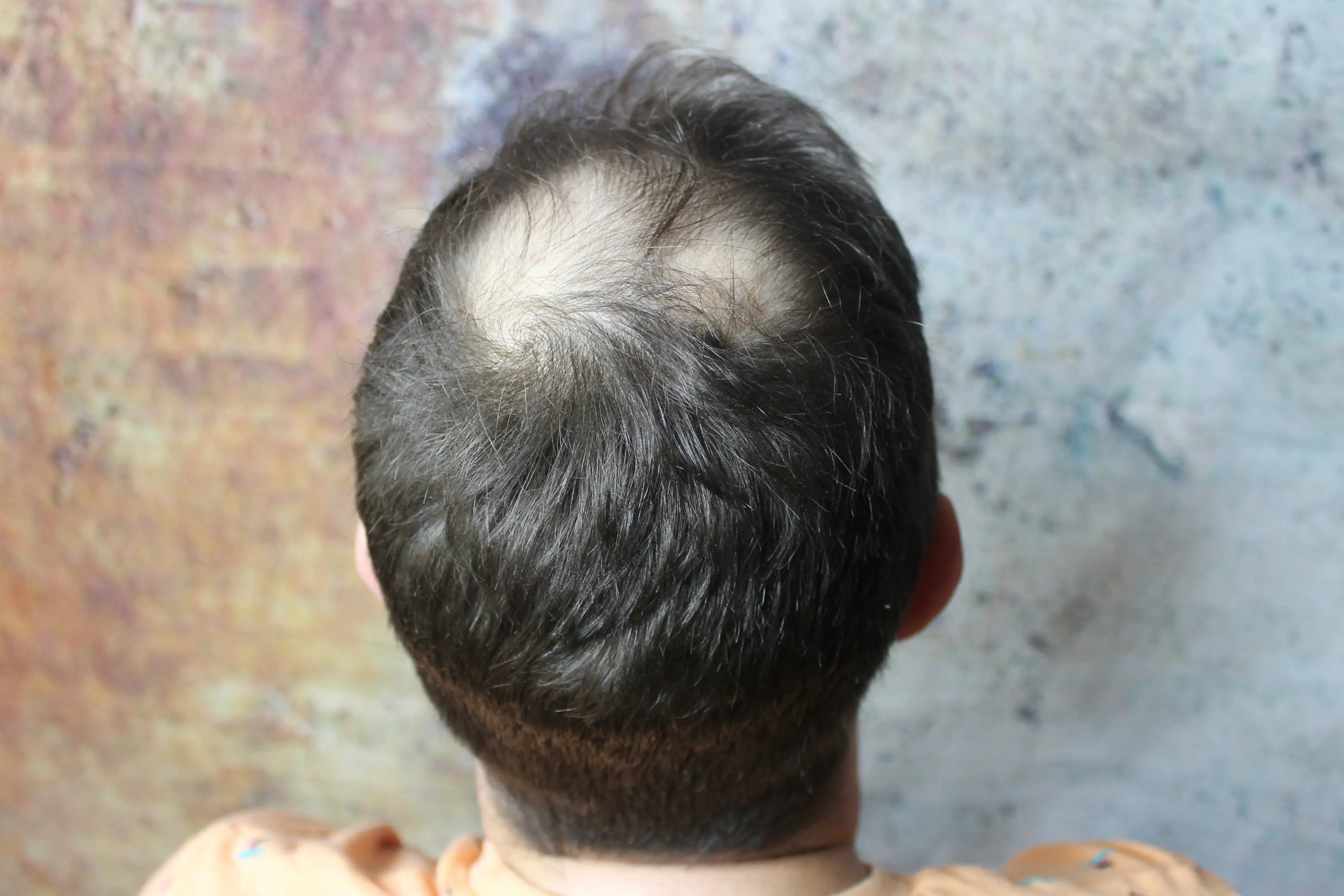 Mann mit Kahlstellen, der das Fiberhair® Haarpuder Spray anwendet, um das Haarvolumen und die Haardichte sofort zu verbessern.